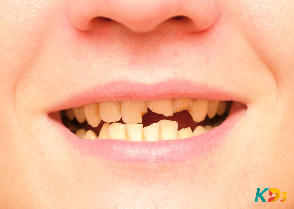 Dentes frágeis e quebradiços: saiba como cuidar