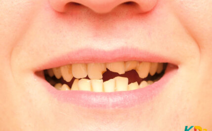 Dentes frágeis e quebradiços: saiba como cuidar